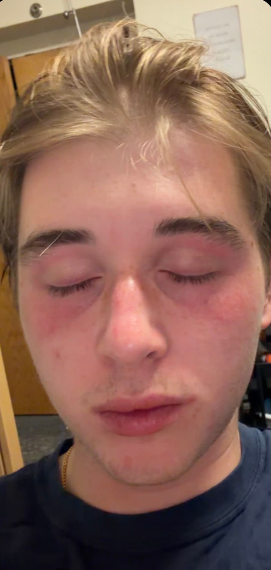 Andrew Hopper — close-up showing a rosacea flare